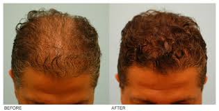 Hair Transplant Service